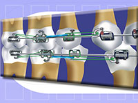 Sistema de Retracción Orthokinetico
